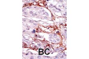 Formalin-fixed and paraffin-embedded human cancer tissue reacted with STK31 polyclonal antibody  , which was peroxidase-conjugated to the secondary antibody, followed by DAB staining.