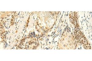 Immunohistochemistry of paraffin-embedded Human esophagus cancer tissue using HMBOX1 Polyclonal Antibody at dilution of 1:50(x200) (HMBOX1 antibody)