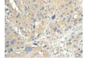 IHC-P analysis of Human Esophagus Cancer Tissue, with DAB staining.