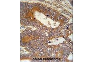 P1S Antibody (Center) (ABIN651956 and ABIN2840474) immunohistochemistry analysis in forlin fixed and paraffin embedded hun colon carcino followed by peroxidase conjugation of the secondary antibody and DAB staining. (MAP1S antibody  (AA 493-520))