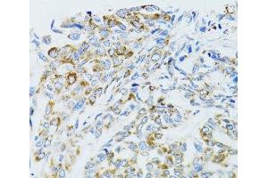 Immunohistochemistry of paraffin-embedded Human liver cancer using EGFR Polyclonal Antibody at dilution of 1:100 (40x lens). (EGFR antibody)