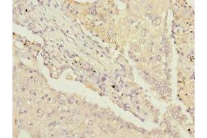 Immunohistochemistry of paraffin-embedded human lung cancer using ABIN7142207 at dilution of 1:100 (PSMD13 antibody  (Regulatory Subunit 13))