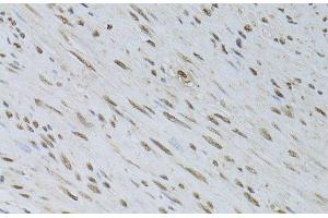 Immunohistochemistry of paraffin-embedded Human uterine cancer using HDGFRP3 Polyclonal Antibody at dilution of 1:100 (40x lens).