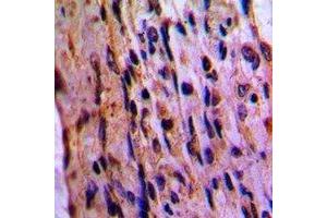 Immunohistochemical analysis of EIF3D staining in human lung cancer formalin fixed paraffin embedded tissue section. (EIF3D antibody)