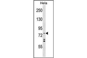 Formalin-fixed and paraffin-embedded human cancer tissue reacted with the primary antibody, which was peroxidase-conjugated to the secondary antibody, followed by AEC staining. (ATG7 antibody  (AA 501-531))