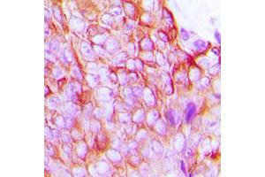 Immunohistochemical analysis of Connexin 43 (pS368) staining in human breast cancer formalin fixed paraffin embedded tissue section. (Connexin 43/GJA1 antibody  (C-Term, pSer368))