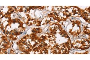Immunohistochemistry of paraffin-embedded Human thyroid cancer tissue using ADNP Polyclonal Antibody at dilution 1:50