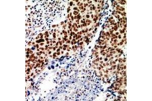 Immunohistochemical analysis of TEAD2 staining in human breast cancer formalin fixed paraffin embedded tissue section. (TEAD2 antibody)