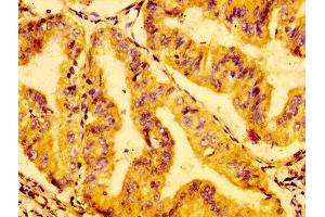 IHC image of ABIN7154498 diluted at 1:100 and staining in paraffin-embedded human cervical cancer performed on a Leica BondTM system. (GRB14 antibody  (AA 294-397))