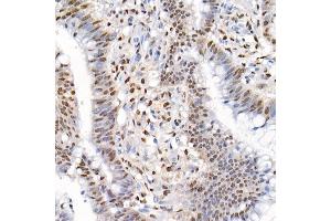 Immunohistochemistry of paraffin-embedded human colon carcinoma using Phospho-Smad2-S465/467 + Smad3-S423/425 Rabbit pAb (ABIN6135314, ABIN6136248, ABIN6136249 and ABIN6225575) at dilution of 1:50 (40x lens). (SMAD2 / SMAD3 (pSer423), (pSer425) antibody)