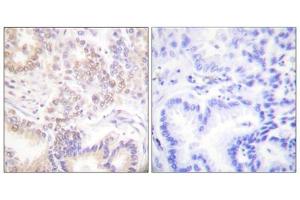 Immunohistochemistry analysis of paraffin-embedded human lung carcinoma tissue using SENP5 antibody. (SENP5 antibody  (C-Term))