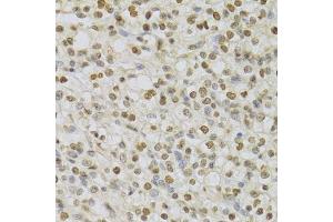 Immunohistochemistry of paraffin-embedded human kidney cancer using HDGF Antibody.