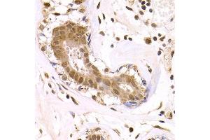 Immunohistochemistry of paraffin-embedded human breast cancer using ODC1 antibody at dilution of 1:200 (400x lens). (ODC1 antibody)