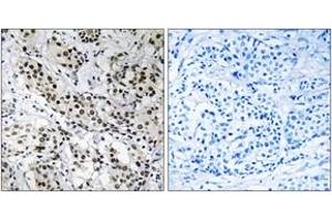 Immunohistochemistry analysis of paraffin-embedded human breast carcinoma tissue, using APBB2 Antibody. (APBB2 antibody  (AA 471-520))