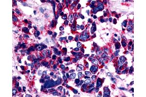 Anti-EDNRA / Endothelin A Receptor antibody IHC of human Lung, Small Cell Carcinoma. (Endothelin-1 Receptor antibody  (Extracellular Domain))