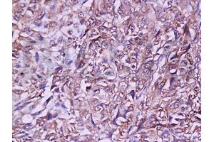 Formalin-fixed and paraffin embedded rat lymphoma tissue labeled with Anti-Ly-6G/Gr-1 Polyclonal Antibody, Unconjugated (ABIN742305) at 1:200 followed by conjugation to the secondary antibody and DAB staining (Ly6g antibody)