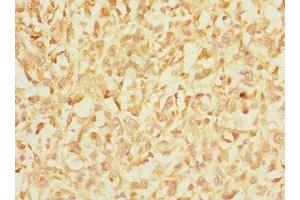 Immunohistochemistry of paraffin-embedded human melanoma using ABIN7156455 at dilution of 1:100 (CD103 antibody  (AA 19-200))