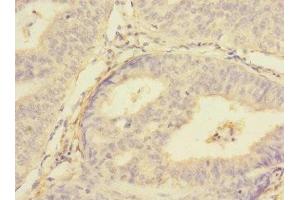 Immunohistochemistry of paraffin-embedded human endometrial cancer using ABIN7159959 at dilution of 1:100 (PMPCA antibody  (AA 456-525))