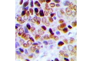 Immunohistochemical analysis of TCEAL1 staining in human prostate cancer formalin fixed paraffin embedded tissue section. (TCEAL1 antibody)