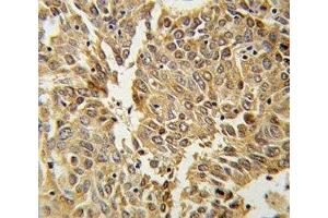 HIF1 alpha antibody IHC analysis in formalin fixed and paraffin embedded lung carcinoma. (HIF1A antibody  (AA 1-30))
