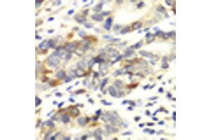 Immunohistochemistry of paraffin-embedded human colon carcinoma using APLP1 antibody (ABIN5971433) at dilution of 1/100 (40x lens). (APLP1 antibody)