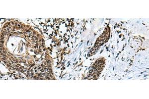 Immunohistochemistry of paraffin-embedded Human esophagus cancer tissue using GLI1 Polyclonal Antibody at dilution of 1:40(x200) (GLI1 antibody)