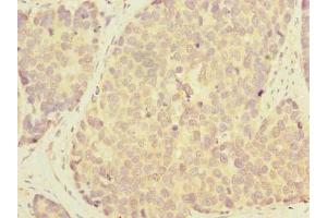 Immunohistochemistry of paraffin-embedded human gastric cancer using ABIN7163860 at dilution of 1:100 (GALNT12 antibody  (AA 1-272))