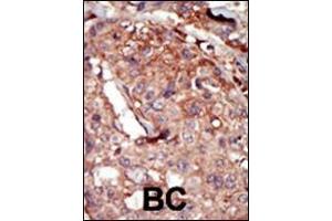 Formalin-fixed and paraffin-embedded human cancer tissue reacted with the primary antibody, which was peroxidase-conjugated to the secondary antibody, followed by AEC staining. (BRD2 antibody  (AA 170-200))