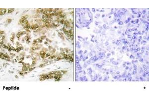 Immunohistochemistry analysis of paraffin-embedded human breast carcinoma tissue using TBX15/TBX18 polyclonal antibody . (T-Box 15 antibody)