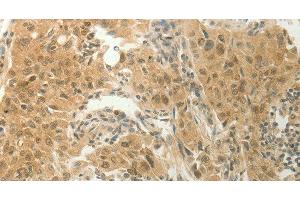Immunohistochemistry of paraffin-embedded Human lung cancer tissue using SLC8A3 Polyclonal Antibody at dilution 1:70 (SLC8A3 antibody)