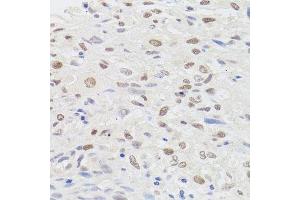 Immunohistochemistry of paraffin-embedded human lung cancer using HMGN1 antibody. (HMGN1 antibody  (AA 1-100))