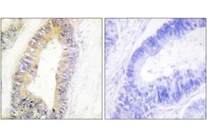 Immunohistochemistry analysis of paraffin-embedded human colon carcinoma tissue, using ZNF638 Antibody.
