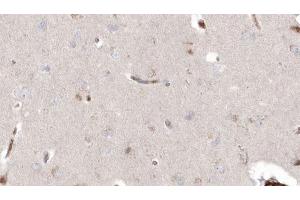 ABIN6272914 at 1/100 staining Human brain cancer tissue by IHC-P. (DHRS3 antibody  (Internal Region))