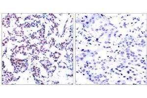 Immunohistochemical analysis of paraffin-embedded human breast carcinoma using JunB (phospho-Ser259) antibody (E011027). (JunB antibody  (pSer259))