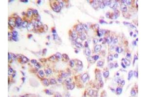 Immunohistochemistry Analysis: AP20205PU-N APC1 antibody staining of Paraffin-Embedded Human breast carcinoma tissue. (APC1 antibody)