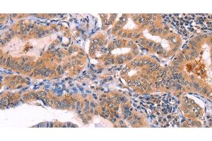 Immunohistochemistry of paraffin-embedded Human thyroid cancer using NCEH1 Polyclonal Antibody at dilution of 1:80 (NCEH1 antibody)