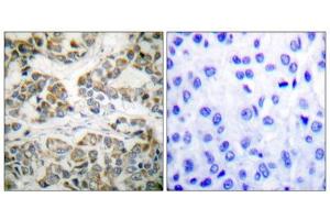 Immunohistochemical analysis of paraffin-embedded human breast carcinoma tissue using Shc (phospho-Tyr349) antibody. (SHC1 antibody  (pTyr349))