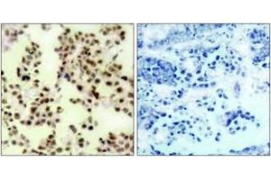 Immunohistochemistry analysis of paraffin-embedded human lung carcinoma, using p73 (Phospho-Tyr99) Antibody. (Tumor Protein p73 antibody  (pTyr99))