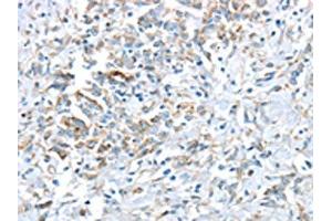 The image on the left is immunohistochemistry of paraffin-embedded Human gastric cancer tissue using ABIN7193036(VWCE Antibody) at dilution 1/30, on the right is treated with synthetic peptide. (VWCE antibody)
