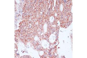 Immunohistochemistry of paraffin-embedded human colon carcinoma using RPL30 antibody (ABIN6130903, ABIN6147135, ABIN6147136 and ABIN6217777) at dilution of 1:100 (40x lens). (RPL30 antibody  (AA 1-115))