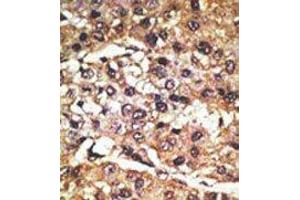 Formalin-fixed and paraffin-embedded human cancer tissue reacted with the primary antibody, which was peroxidase-conjugated to the secondary antibody, followed by DAB staining. (GPR37 antibody  (N-Term))