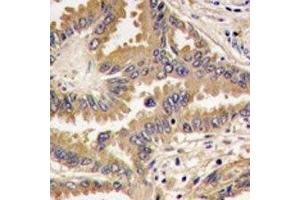 IHC analysis of FFPE human lung carcinoma tissue stained with Bad antibody (BAD antibody  (AA 53-81))