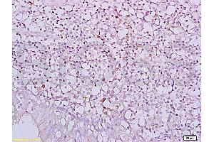 Formalin-fixed and paraffin embedded human nasopharyngeal carcinoma labeled with Anti-NKG2D/CD314/KLRK1 Polyclonal Antibody, Unconjugated (ABIN730078) at 1:200, followed by conjugation to the secondary antibody and DAB staining