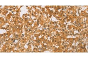 Immunohistochemistry of paraffin-embedded Human thyroid cancer tissue using CEBP beta Polyclonal Antibody at dilution 1:60 (CEBPB antibody)