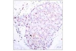 Immunohistochemical analysis of paraffin-embedded human breast carcinoma tissue using NFKB1 polyclonal antibody . (NFKB1 antibody)