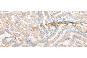 Immunohistochemistry of paraffin-embedded Human thyroid cancer tissue using CELA3A Polyclonal Antibody at dilution of 1:25(x200) (Elastase 3A antibody)