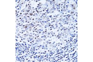 Immunohistochemistry of paraffin-embedded human vermiform appendix using PARP1 Antibody (ABIN5975769) at dilution of 1/100 (40x lens). (PARP1 antibody)