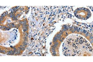 Immunohistochemistry of paraffin-embedded Human colon cancer tissue using EFNB2 Polyclonal Antibody at dilution 1:80 (Ephrin B2 antibody)