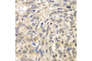 Immunohistochemistry of paraffin-embedded human esophageal cancer using TLK2 antibody at dilution of 1:100 (x40 lens). (TLK2 antibody)