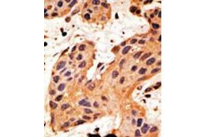 Formalin-fixed and paraffin-embedded human cancer tissue reacted with the primary antibody, which was peroxidase-conjugated to the secondary antibody, followed by DAB staining.
